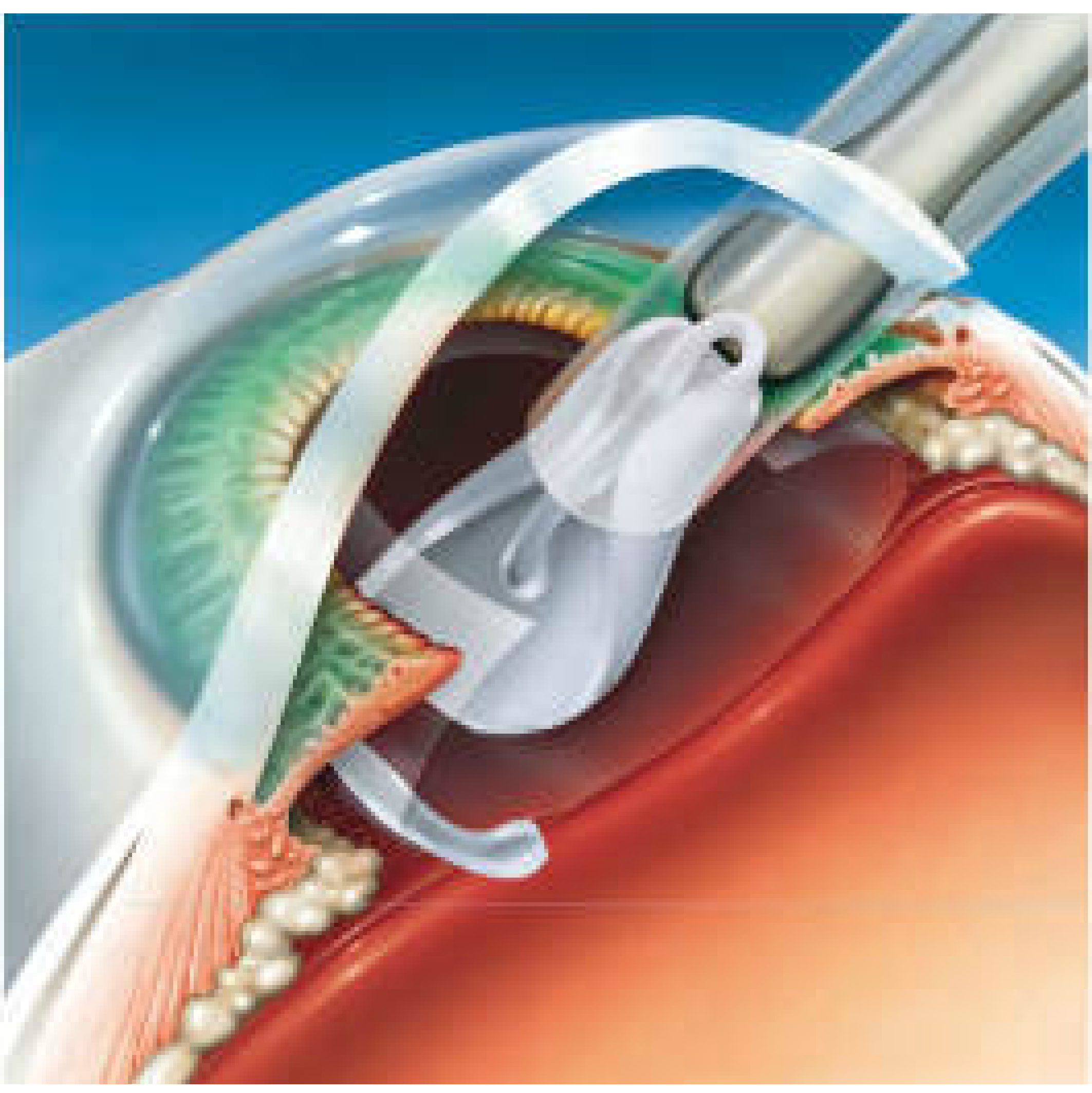 09-Steps-of-surgery1-sm-02